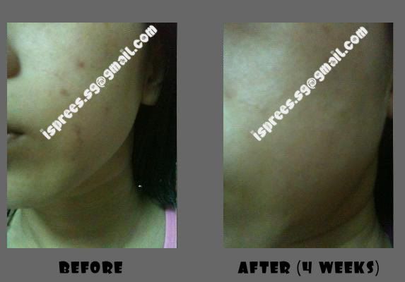 Microdermabrasion For Acne Scars Before And After Photos. MicroDermabrasion 2 Reduces